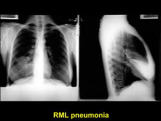 Interpretation of Chest X-Ray PPT | PPT