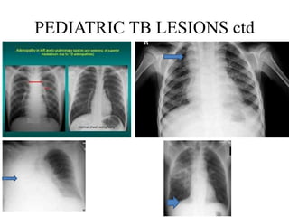 CXR interpretation in TB patients | PPTX