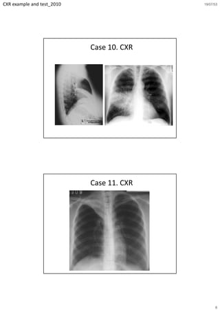 CXR example and test_2010                  19/07/53




                            Case 10. CXR




                            Case 11. CXR




                                                 6
 