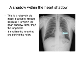 Interpretation of Chest X-Rays for Y3 medical students | PPTX
