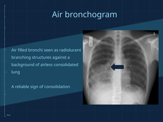 Introduction to Chest X-rays for medical students 2022 | PPTX