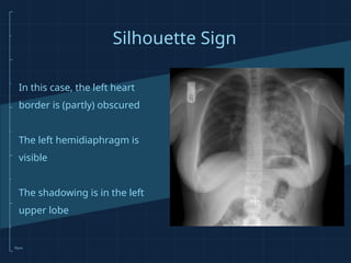 Introduction to Chest X-rays for medical students 2022 | PPTX