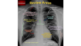 Chest X-Ray (CXR) Interpretation Made Easy: A Comprehensive Guide to ...