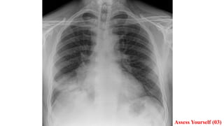 Chest X-Ray (CXR) Interpretation Made Easy: A Comprehensive Guide to ...