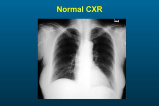Normal CXR 