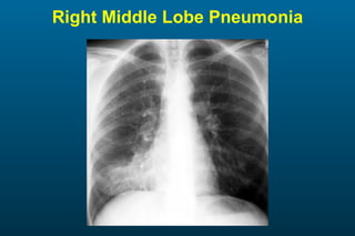 Right Middle Lobe Pneumonia 
