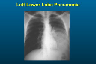 Left Lower Lobe Pneumonia 