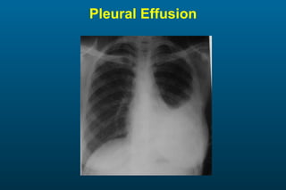 Pleural Effusion 