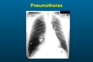 Pneumothorax 