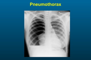 Pneumothorax 