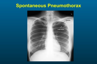 Spontaneous Pneumothorax 