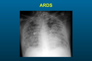 ARDS 
