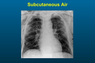 Subcutaneous Air 