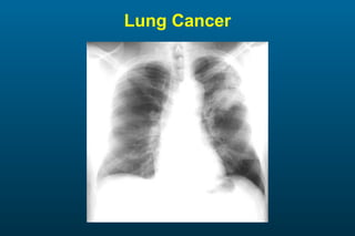 Lung Cancer 