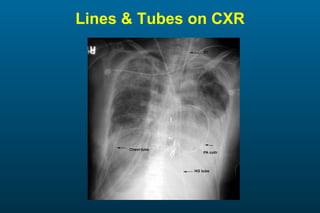 Lines & Tubes on CXR 