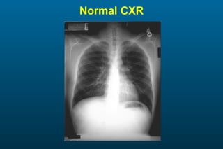 Normal CXR 