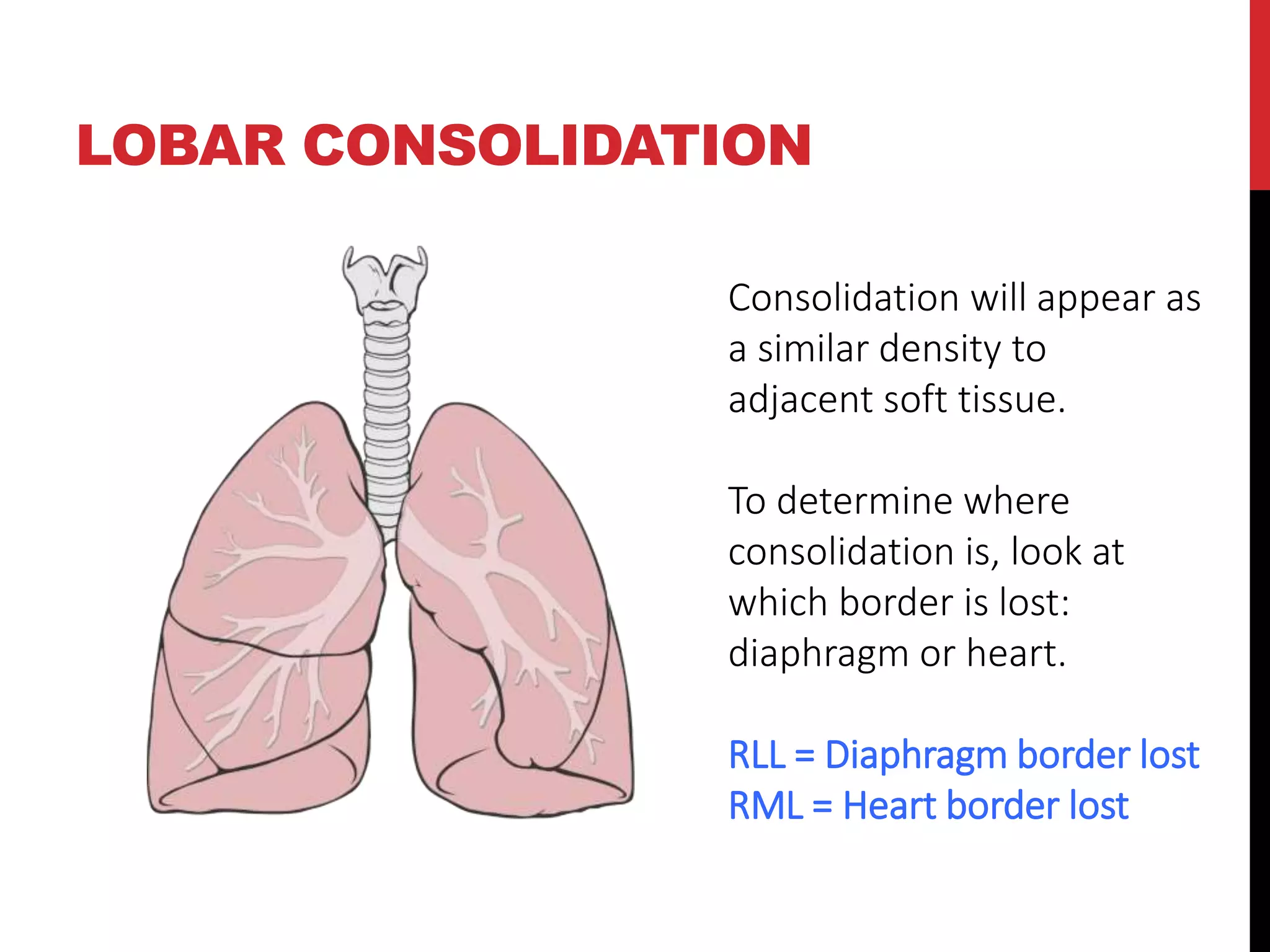 Cxr interpretation | PPTX