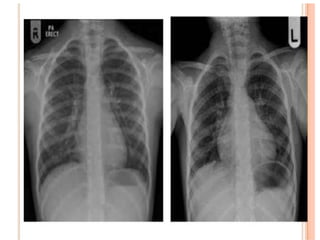 Xgp Radiopaedia Cxr of common heart pathology agp | PPTX