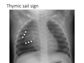 Triangular Sign Chest Cxr of common heart pathology agp | PPTX