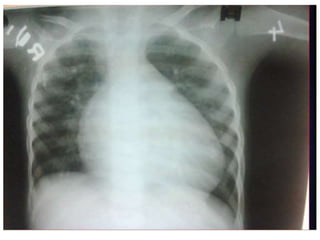 Xgp Radiopaedia Cxr of common heart pathology agp | PPTX