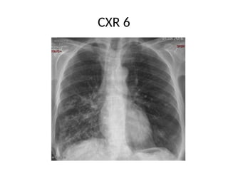 CXR OSCE.pptx in examination point of view | PPTX