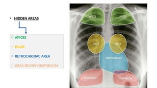 chest xray ppt final for radiology residents | PPTX