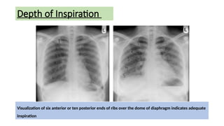 Inspiration Normal Ribs chest xray ppt final for radiology residents | PPTX