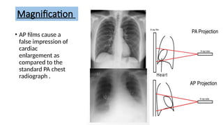Magnification Radiograph chest xray ppt final for radiology residents | PPTX