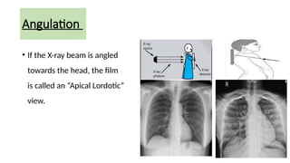 Lordotic View chest xray ppt final for radiology residents | PPTX