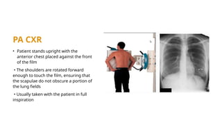 Patient Rotation Cxr Example CXR Presentation for radiology studies for medical students | PPSX