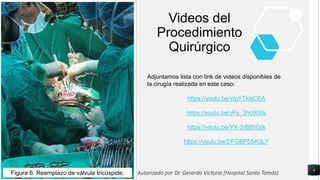 8
Figura 6. Reemplazo de válvula tricúspide.
Videos del
Procedimiento
Quirúrgico
Adjuntamos lista con link de videos disponibles de
la cirugía realizada en este caso:
https://youtu.be/vIpYTksjCEA
https://youtu.be/yFe_3hUXXls
https://youtu.be/YX-2rBBh0zk
https://youtu.be/DFGBP5SK0LY
Autorizado por Dr. Gerardo Victoria (Hospital Santo Tomás)
 