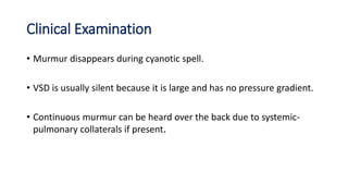 Clinical Examination
• Murmur disappears during cyanotic spell.
• VSD is usually silent because it is large and has no pressure gradient.
• Continuous murmur can be heard over the back due to systemic-
pulmonary collaterals if present.
 