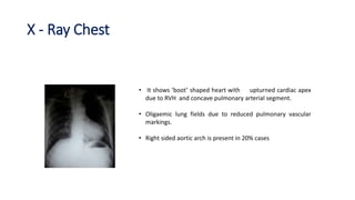 X - Ray Chest
• It shows ‘boot’ shaped heart with upturned cardiac apex
due to RVH and concave pulmonary arterial segment.
• Oligaemic lung fields due to reduced pulmonary vascular
markings.
• Right sided aortic arch is present in 20% cases
 