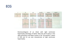 ECG
Electrocardiogram of an infant with right ventricular
hypertrophy (tetralogy of Fallot). Note the tall R waves in the
right precordium and deep S waves in V6. The positive T waves
in V4R and V1 are also characteristic of right ventricular
hypertrophy.
 