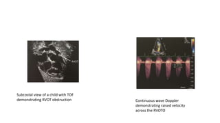 Subcostal view of a child with TOF
demonstrating RVOT obstruction Continuous wave Doppler
demonstrating raised velocity
across the RVOTO
 