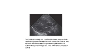This parasternal long-axis 2-dimensional view demonstrates
anterior displacement of the outflow ventricular septum that
resulted in stenosis of the subpulmonic right ventricular
outflow tract, overriding of the aorta with ventricular septal
defect
 