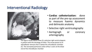 Interventional Radiology
• Cardiac catheterization: done
as part of the pre-op assessment
to measure haemo dynamics
and delineate anatomy
• Selective right ventriculography
• Aortogragh or coronary
arteriography
The figure shows lateral view of a selective right ventriculogram
in patient with the tetralogy of Fallot. The arrow points to an
infundibular stenosis that is below the infundibular chamber
(C). The narrowed pulmonary valve orifice is seen at the distal
end of the infundibular chamber
 