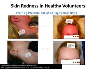 Skin Redness in Healthy Volunteers
After 10 g treatment, photos on Day 1 and on Day 8.
Day 1*
Day 8†
*No flash photography. †Flash photography used.
OHCo, hydroxocobalamin. Uhl W, et al. Clin Toxicol. 2006;44:17-28.
 