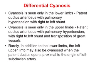 Differential Cyanosis
• Cyanosis is seen only in the lower limbs - Patent
ductus arteriosus with pulmonary
hypertension,with right to left shunt
• Cyanosis is seen only in the upper limbs - Patent
ductus arteriosus with pulmonary hypertension,
with right to left shunt and transposition of great
vessels
• Rarely, in addition to the lower limbs, the left
upper limb may also be cyanosed when the
patent ductus opens proximal to the origin of left
subclavian artery
 
