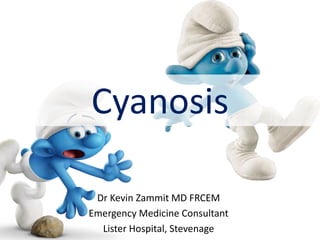 Cyanosis
Dr Kevin Zammit MD FRCEM
Emergency Medicine Consultant
Lister Hospital, Stevenage
 