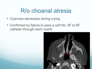 R/o choanal atresia
 Cyanosis decreases during crying
 Confirmed by failure to pass a soft No. 5F to 8F
catheter through each nostril
 