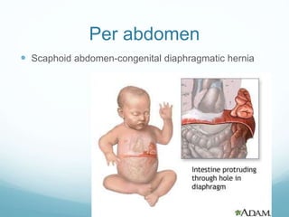 Per abdomen
 Scaphoid abdomen-congenital diaphragmatic hernia
 