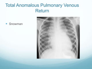 Total Anomalous Pulmonary Venous
Return
 Snowman
 