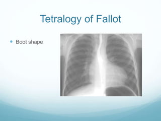 Tetralogy of Fallot
 Boot shape
 