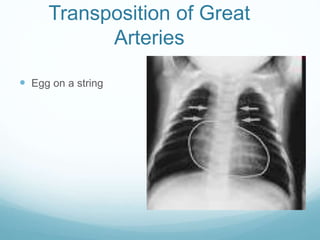 Transposition of Great
Arteries
 Egg on a string
 