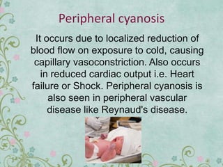 Peripheral cyanosis
It occurs due to localized reduction of
blood flow on exposure to cold, causing
capillary vasoconstriction. Also occurs
in reduced cardiac output i.e. Heart
failure or Shock. Peripheral cyanosis is
also seen in peripheral vascular
disease like Reynaud's disease.
 