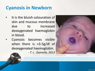 Cyanosis in Newborn
• It is the bluish colouration of
skin and mucous membrane
due to increased
deoxygenated haemoglobin
in blood.
• Cyanosis becomes visible
when there is >3-5g/dl of
deoxygenated haemoglobin.
- T. L . Gomella, 2013
 