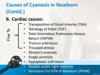 Causes of Cyanosis in Newborn
(Contd.)
B. Cardiac causes:
• Transposition of Great Arteries (TGA)
• Tetralogy of Fallot (TOF)
• Total Anomalous Pulmonary Venous
Return (TAPVR)
• Truncus arteriosus
• Tricuspid atresia
• Ebstien’s anomaly
• Single ventricle
• Hypoplastic Left Heart
• Double outlet right ventricle
• Persistent Pul HTN of Newborn (PPHN)
FiveTs
 