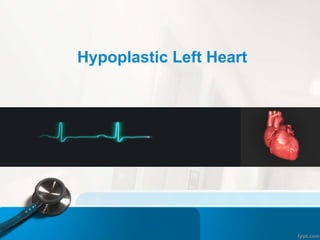 Hypoplastic Left Heart
 