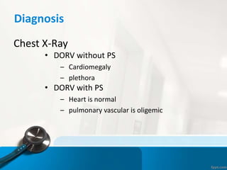 Diagnosis
Chest X-Ray
• DORV without PS
– Cardiomegaly
– plethora
• DORV with PS
– Heart is normal
– pulmonary vascular is oligemic
 